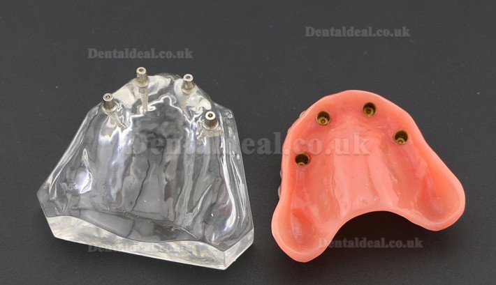 Dental Study Teeth Model Overdenture Superior With 4 Implants Demo Model 6001