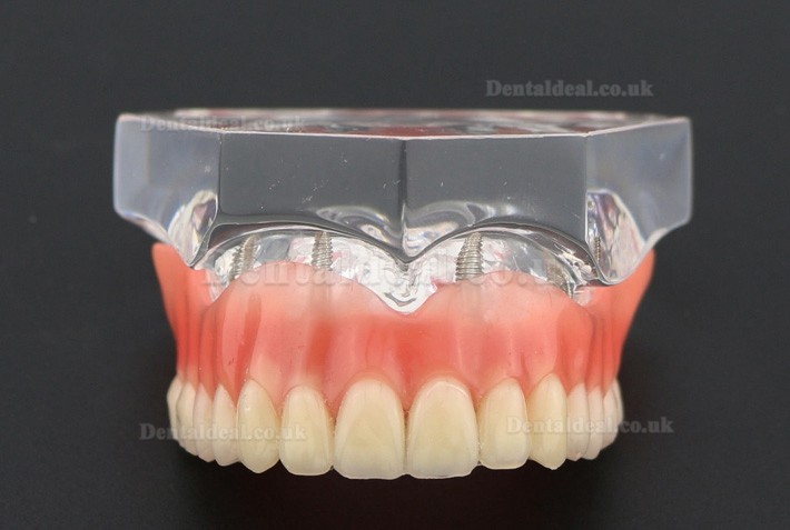 Dental Study Teeth Model Overdenture Superior With 4 Implants Demo Model 6001