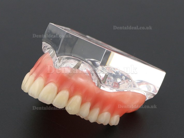 Dental Study Teeth Model Overdenture Superior With 4 Implants Demo Model 6001