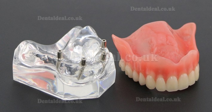 Dental Study Teeth Model Overdenture Superior With 4 Implants Demo Model 6001