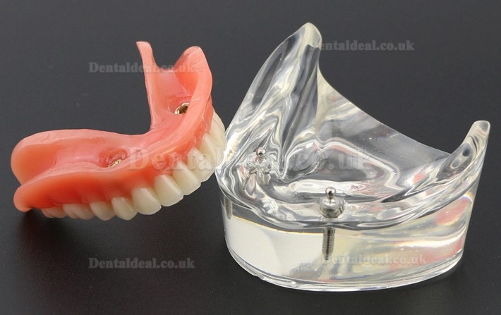 Dental Teeth Model Overdenture Inferior with 2 Implants Study Demo Model 6002 01