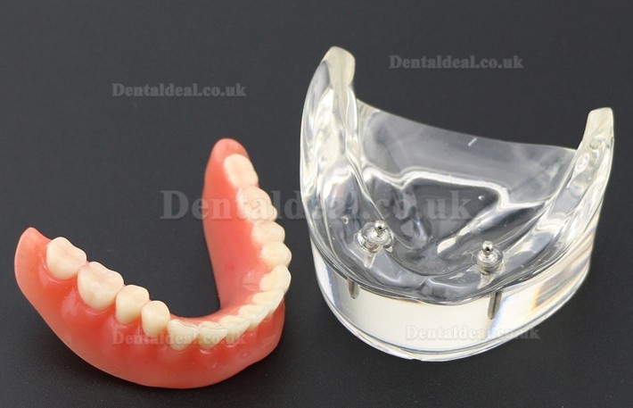 Dental Teeth Model Overdenture Inferior with 2 Implants Study Demo Model 6002 01