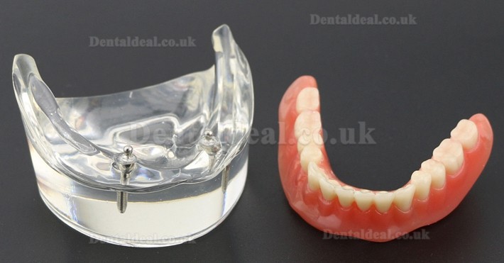 Dental Teeth Model Overdenture Inferior with 2 Implants Study Demo Model 6002 01