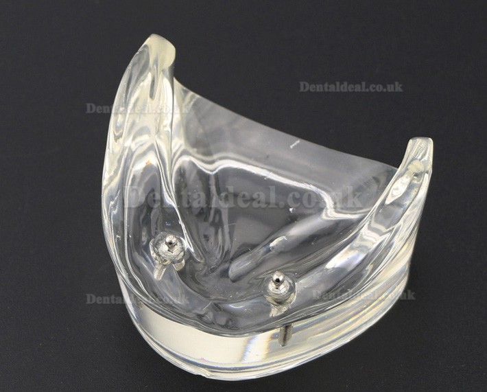 Dental Teeth Model Overdenture Inferior with 2 Implants Study Demo Model 6002 01