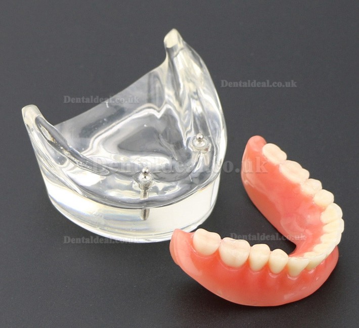 Dental Teeth Model Overdenture Inferior with 2 Implants Study Demo Model 6002 01