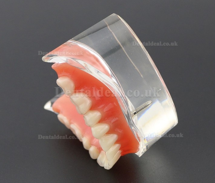 Dental Teeth Model Overdenture Inferior with 2 Implants Study Demo Model 6002 01