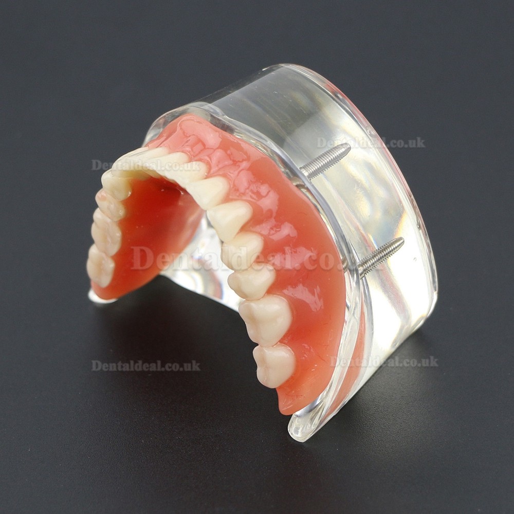 Dental Lower Teeth Demo Study Model 6002 02 Overdenture Inferior 4 Implants