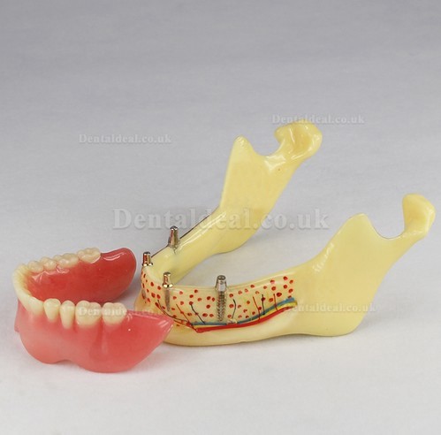 Dental Teeth Implant Model Jaw M-2014B