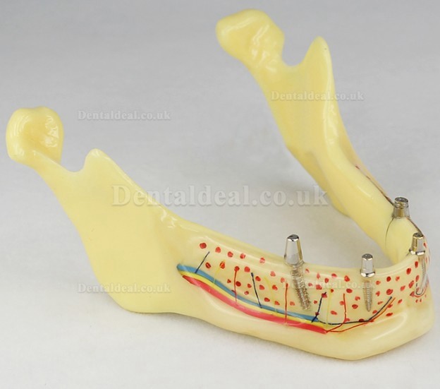 Dental Teeth Implant Model Jaw M-2014B