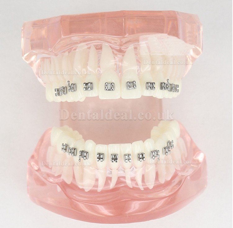 Dental Teeth Malocclusion Correct With Metal Bracket Standard Model M3001