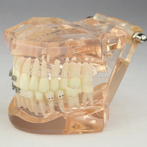 Dental Orthodontic Model with Ceramic Brackets M3009