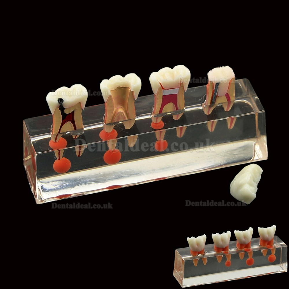 Dental Teeth Model 4-Stage Endodontic Treatment Demonstrates Anatomical M4018-01