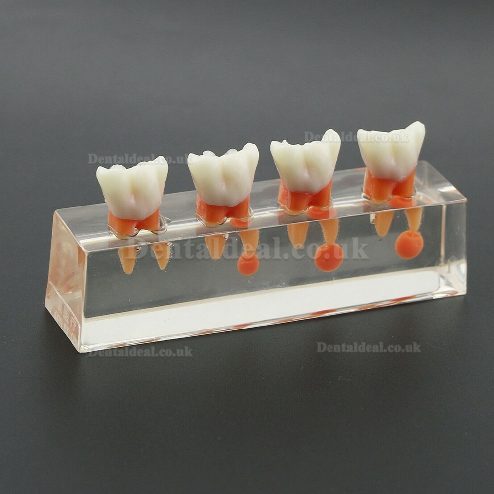 Dental Teeth Model 4-Stage Endodontic Treatment Demonstrates Anatomical M4018