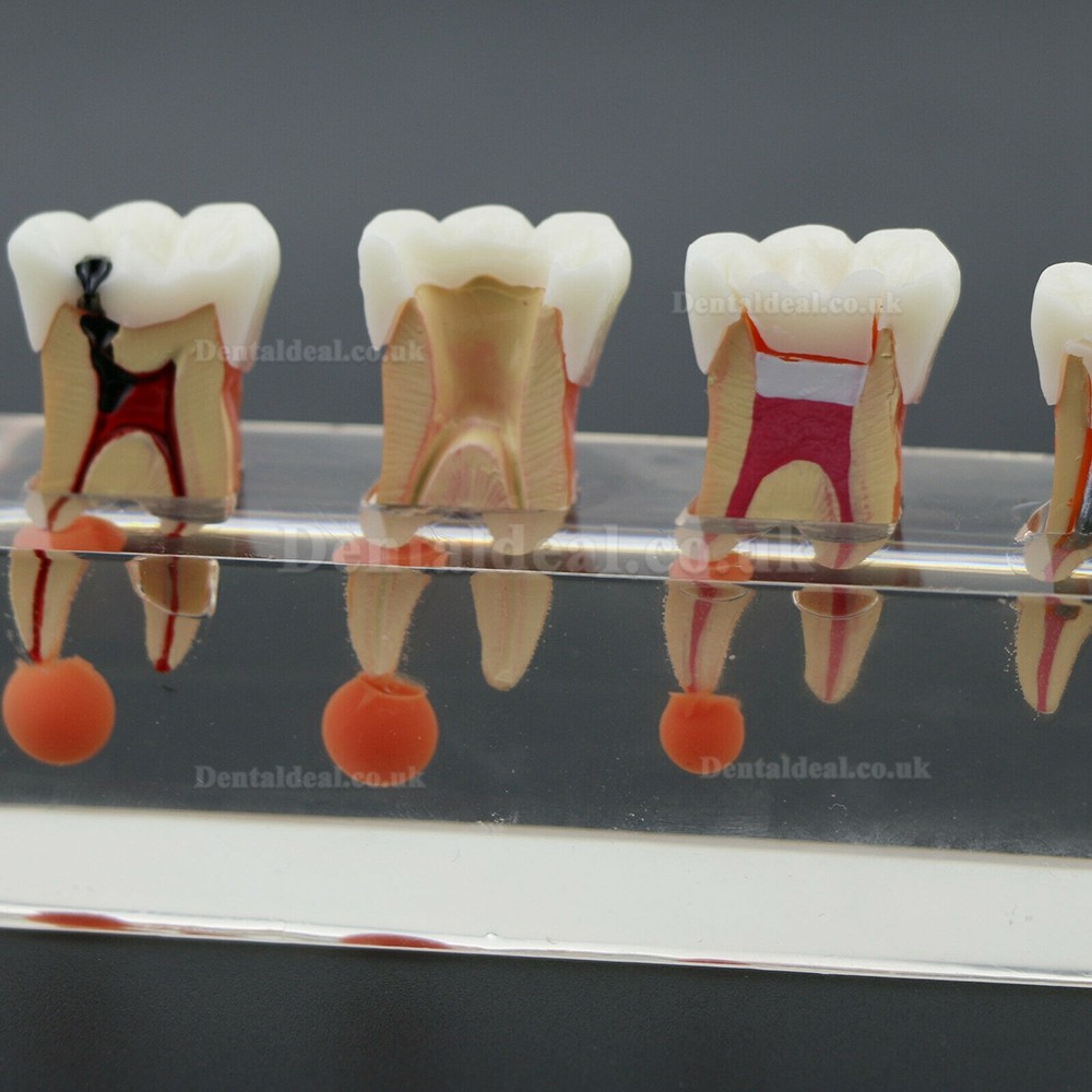 Dental Teeth Model 4-Stage Endodontic Treatment Demonstrates Anatomical M4018-01