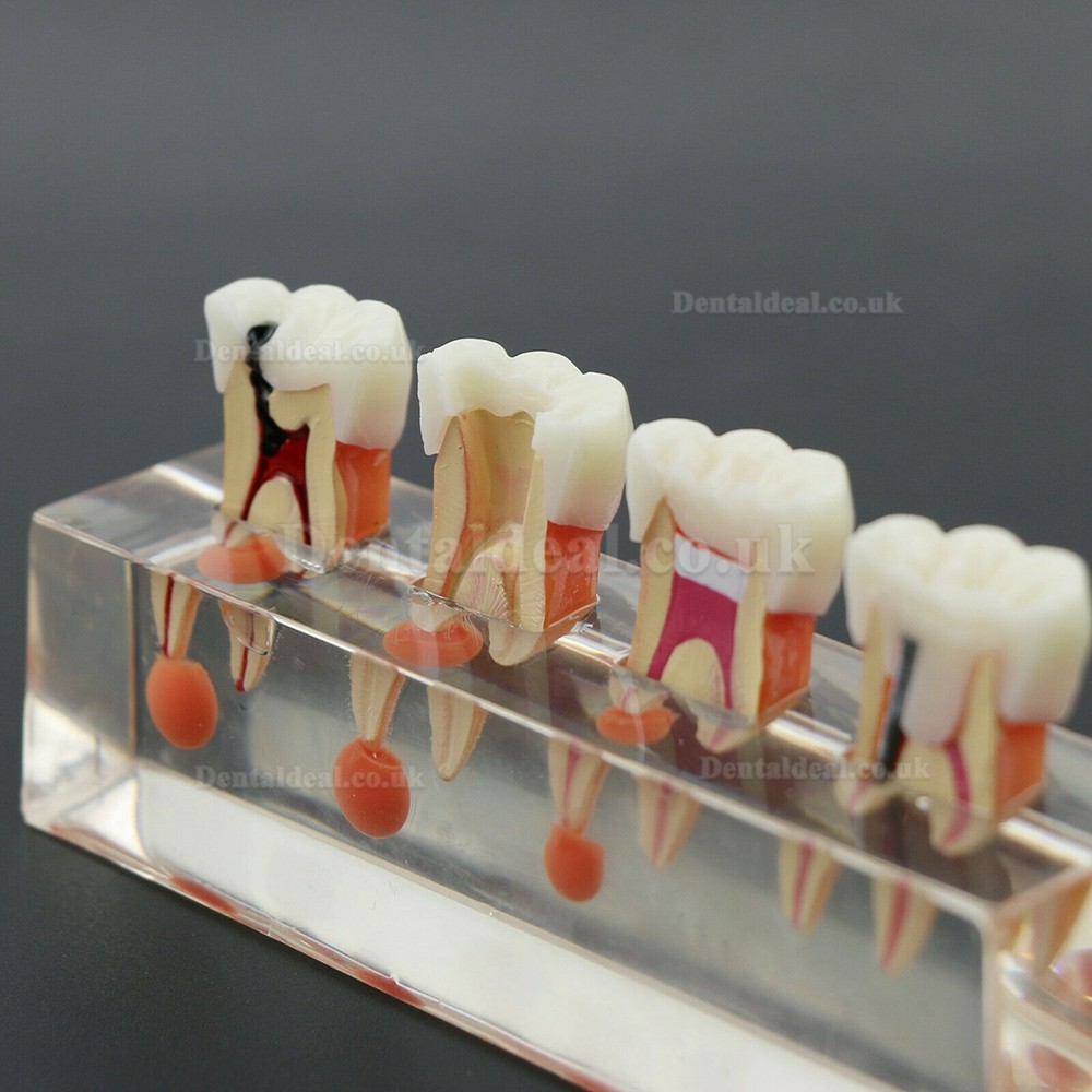 Dental Teeth Model 4-Stage Endodontic Treatment Demonstrates Anatomical M4018