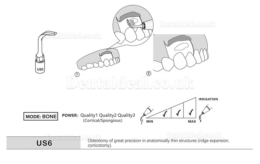 1Pcs Dental Piezosurgery Osteotomy Bone Cutting Dental Surgery Tips US1 US1L US1R US2 US3 US4 US5 US6 US7 US11Fit Mectro