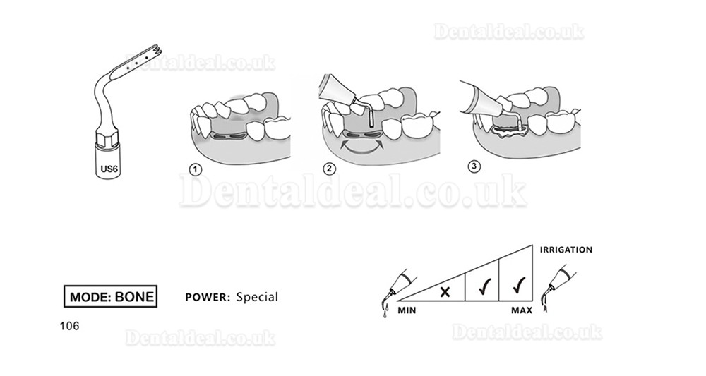 1Pcs Dental Piezosurgery Osteotomy Bone Cutting Dental Surgery Tips US1 US1L US1R US2 US3 US4 US5 US6 US7 US11Fit Mectro