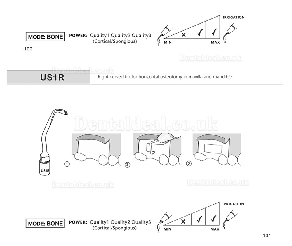 1Pcs Dental Piezosurgery Osteotomy Bone Cutting Dental Surgery Tips US1 US1L US1R US2 US3 US4 US5 US6 US7 US11Fit Mectro