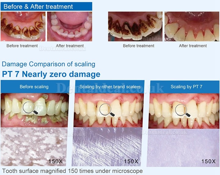 Refine PT 7 Ultrasonic Scaler with Water Supply Periodontal Treatment Device Painless Smart Control