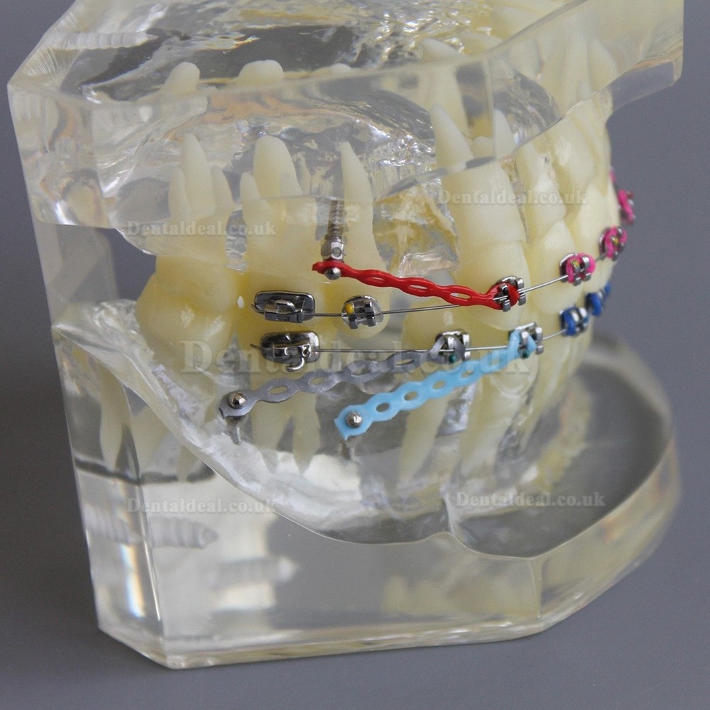 Dental Orthodontic Demonstration Practice Model With Metal Bracket Archwire