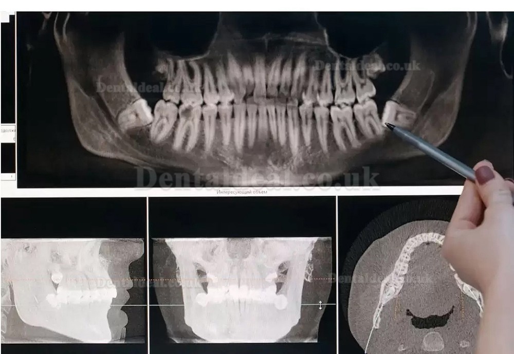 Refine MaxSurgery Dental Piezosurgery Unit Ultrasonic Piezo Bone Surgery System Piezo Surgery Machine