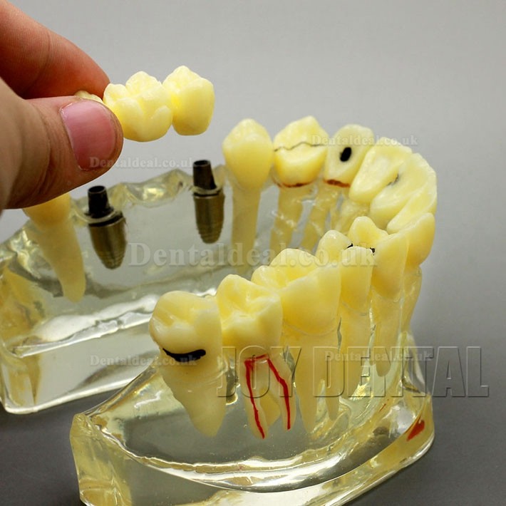 2 Times Enlarged Dental Restoration/ Prothesis/Implant Study model with Bridge