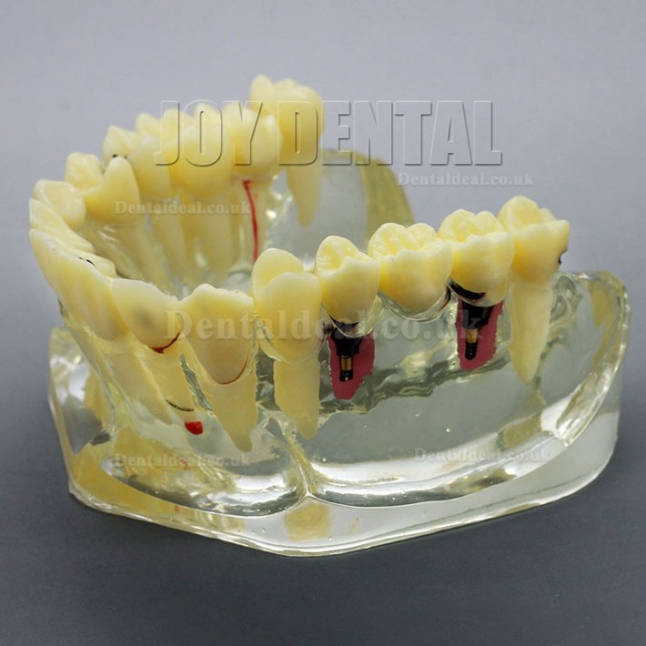 2 Times Enlarged Dental Restoration/ Prothesis/Implant Study model with Bridge