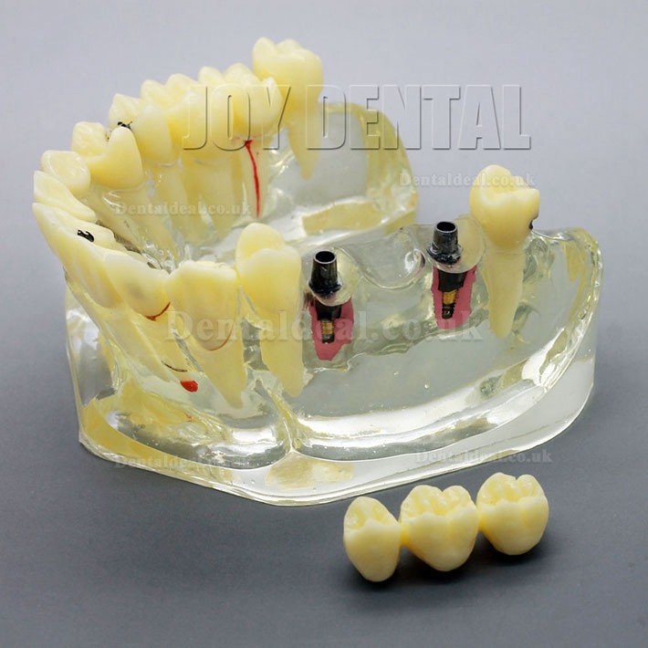 2 Times Enlarged Dental Restoration/ Prothesis/Implant Study model with Bridge