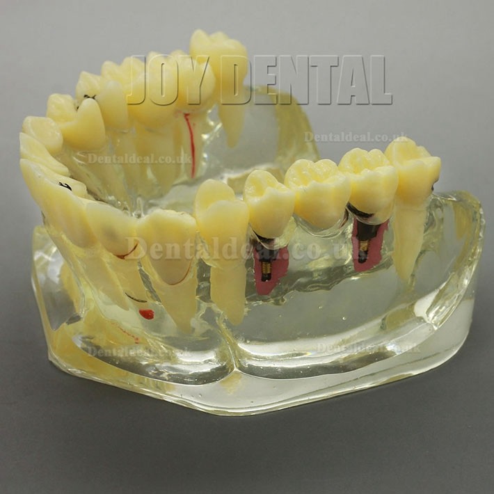 2 Times Enlarged Dental Restoration/ Prothesis/Implant Study model with Bridge