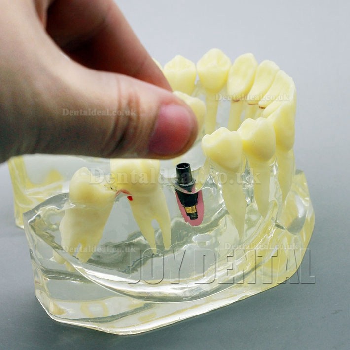 2 Times Enlarged Dental Restoration/ Prothesis/Implant Study model with Bridge