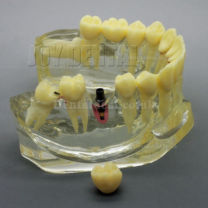 2 Times Enlarged Dental Restoration/ Prothesis/Implant Study model with Bridge