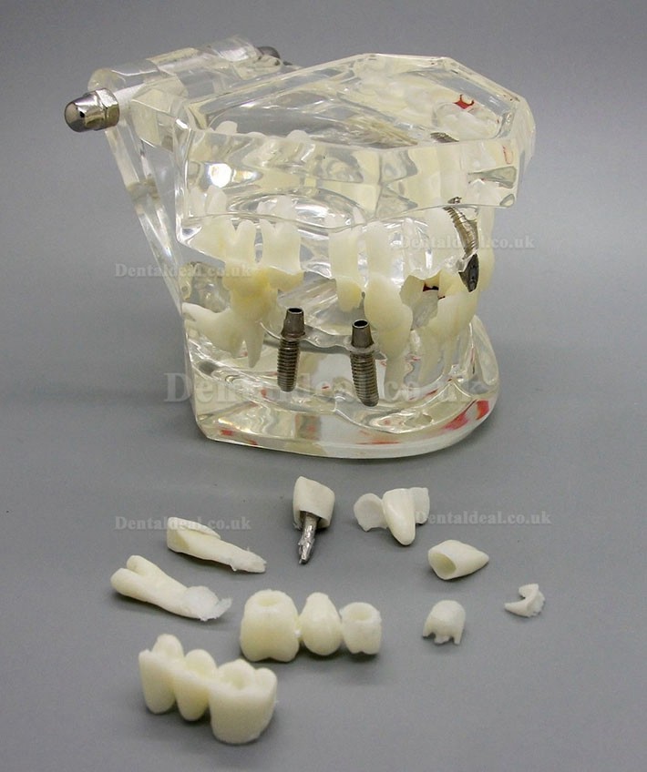 Dental Implant Study Analysis Demonstration Teeth Disease Model with Restoration