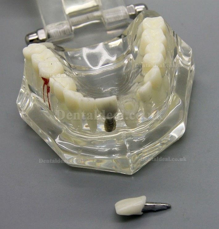 Dental Implant Study Analysis Demonstration Teeth Disease Model with Restoration