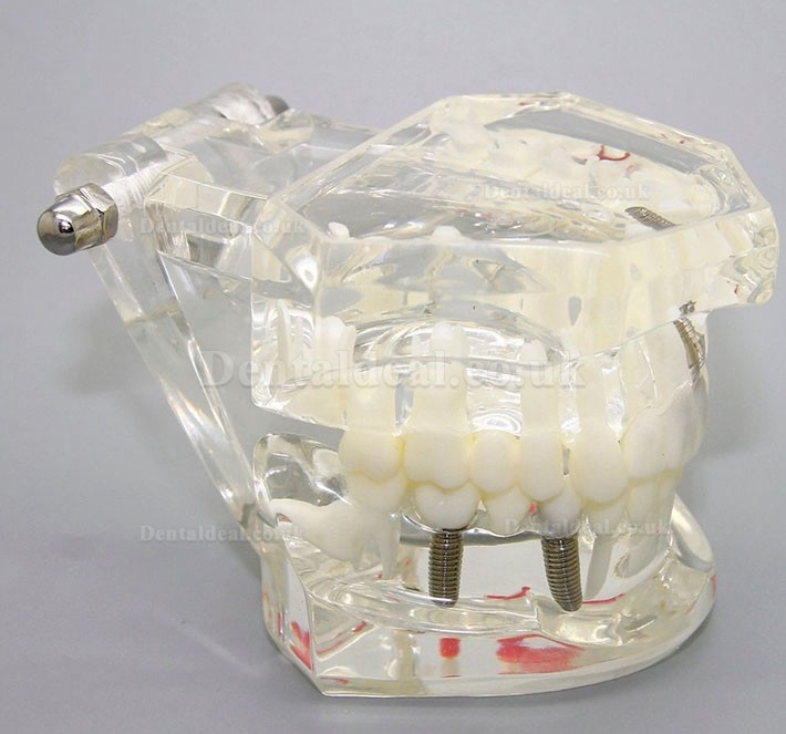 Dental Implant Study Analysis Demonstration Teeth Disease Model with Restoration