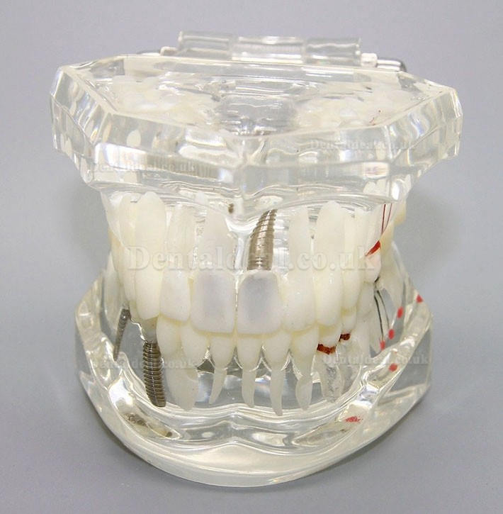 Dental Implant Study Analysis Demonstration Teeth Disease Model with Restoration