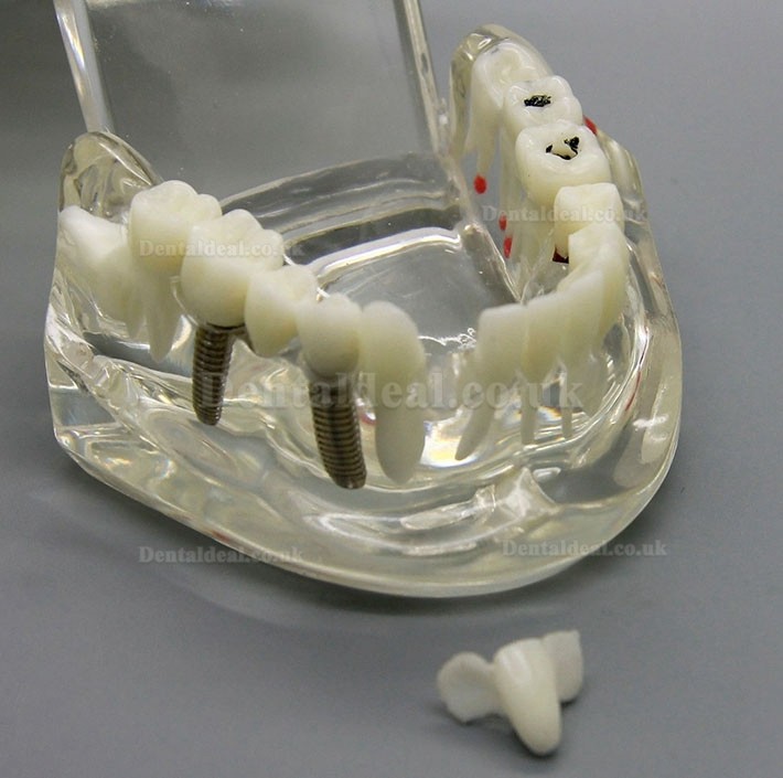 Dental Implant Study Analysis Demonstration Teeth Disease Model with Restoration