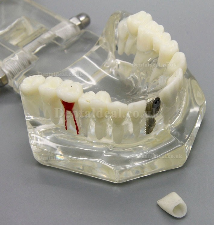 Dental Implant Study Analysis Demonstration Teeth Disease Model with Restoration